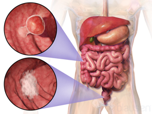 Colorectal cancer - Wikipedia